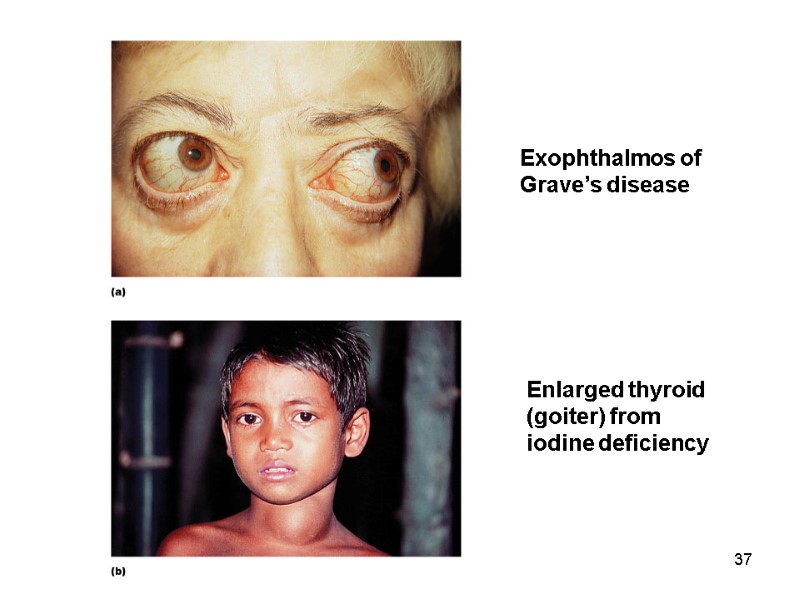 37 Exophthalmos of Grave’s disease Enlarged thyroid (goiter) from iodine deficiency